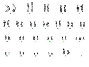 sindrome de edwards cromossomos